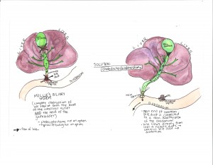Figure 3: Mollie's biliary system and required surgery